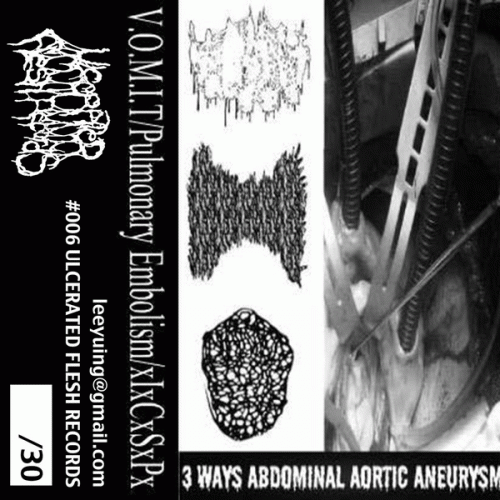 Inhalando Cerebro Seco De Perro : 3 Ways Abdominal Aortic Aneurysm